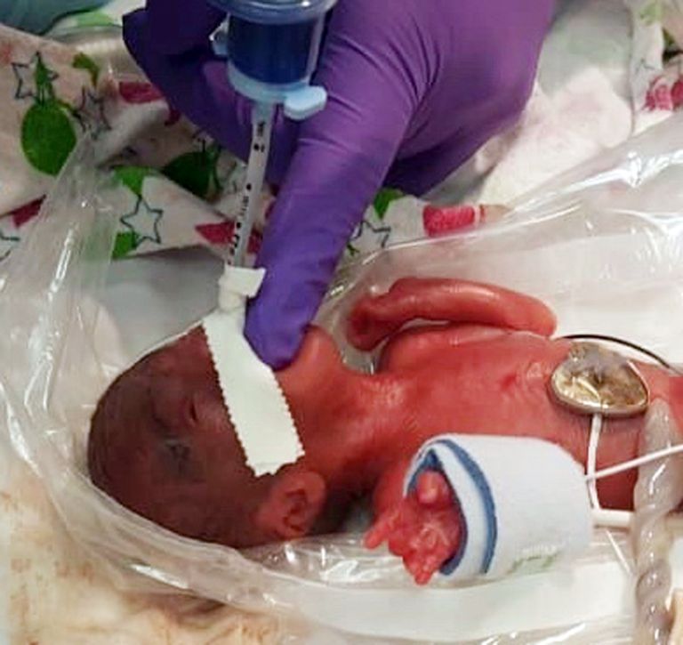 USAs San Diegos sündis 2018. aasta detsembris enneaegne laps, kelle sünnikaal oli 245 grammi