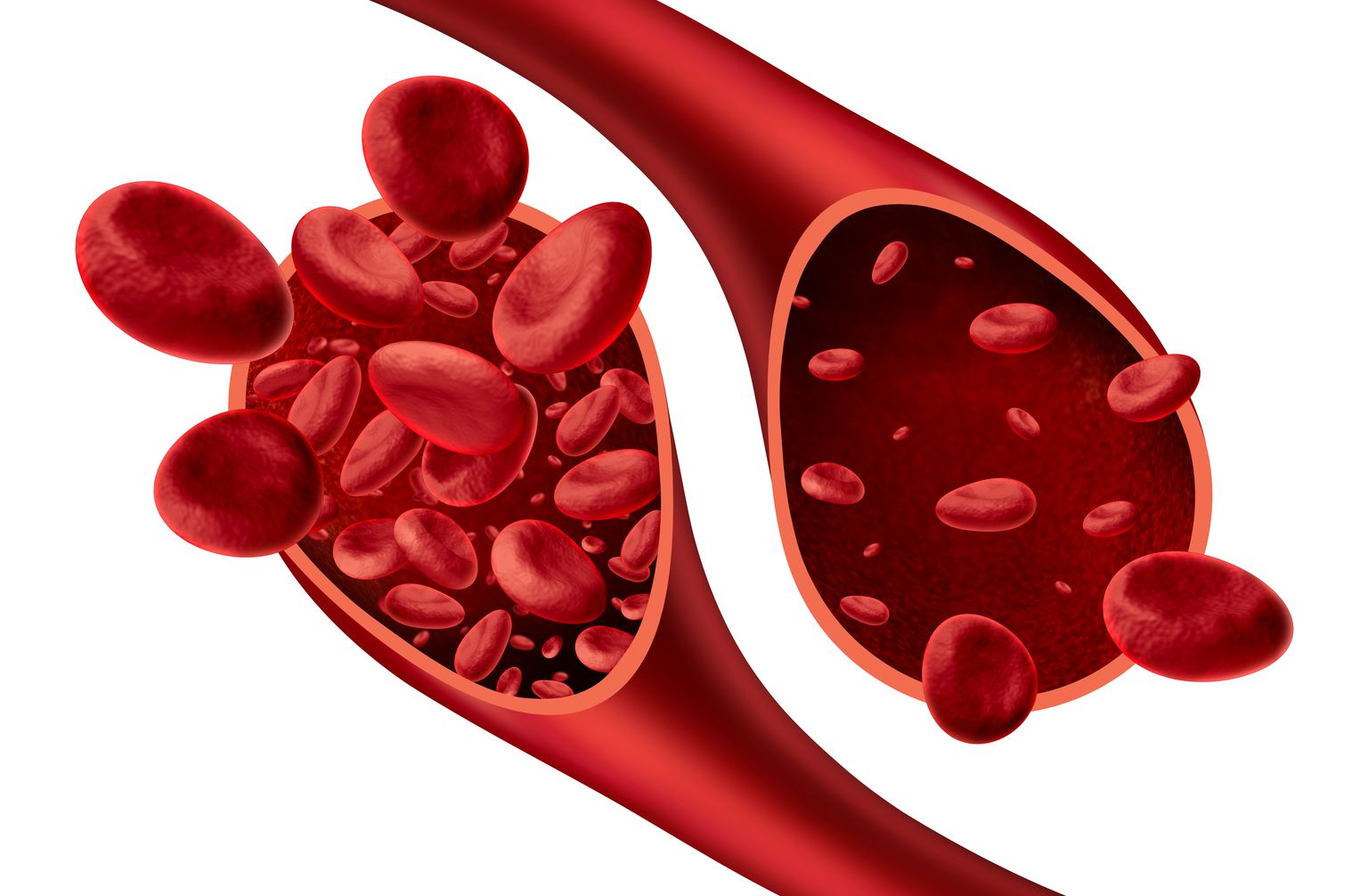 В случае железодефицитной анемии в крови содержится меньше эритроцитов.