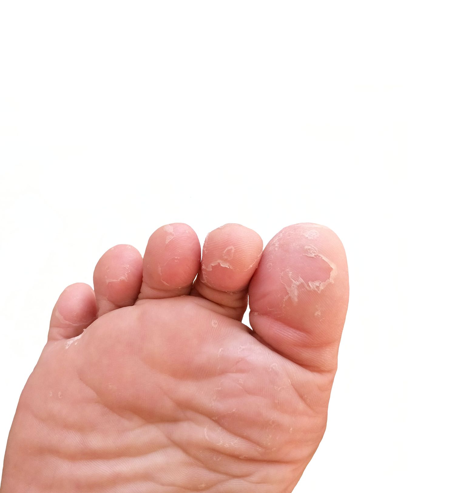 Sageli niiskeid sokke või kitsaid jalanõusid kandes on jalaseene tekkeks suurem risk.