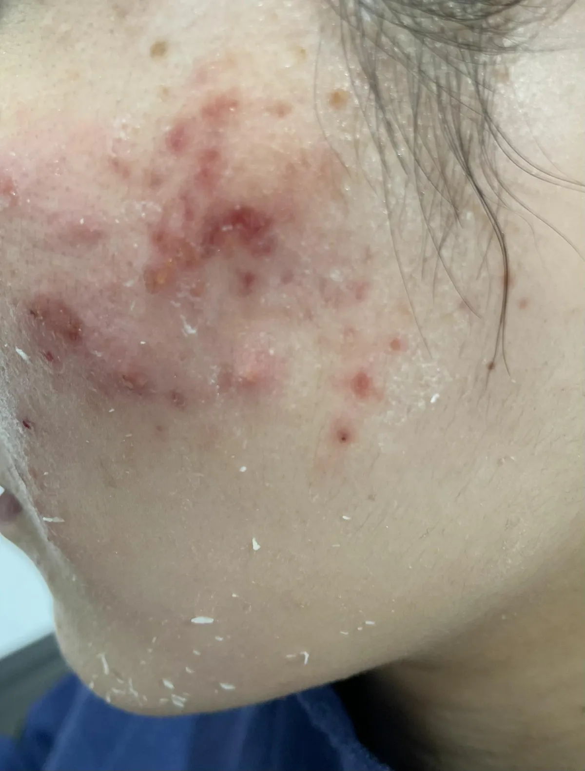Maarika (25) läks ilusüste tegema sooviga veel veidi noorem ja kenam näida, aga sai raske põletiku ning nahakahjustuse. FOTO: