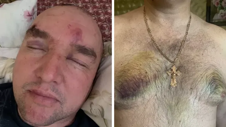 Александр сфотографировал свои синяки после того, как его отпустили