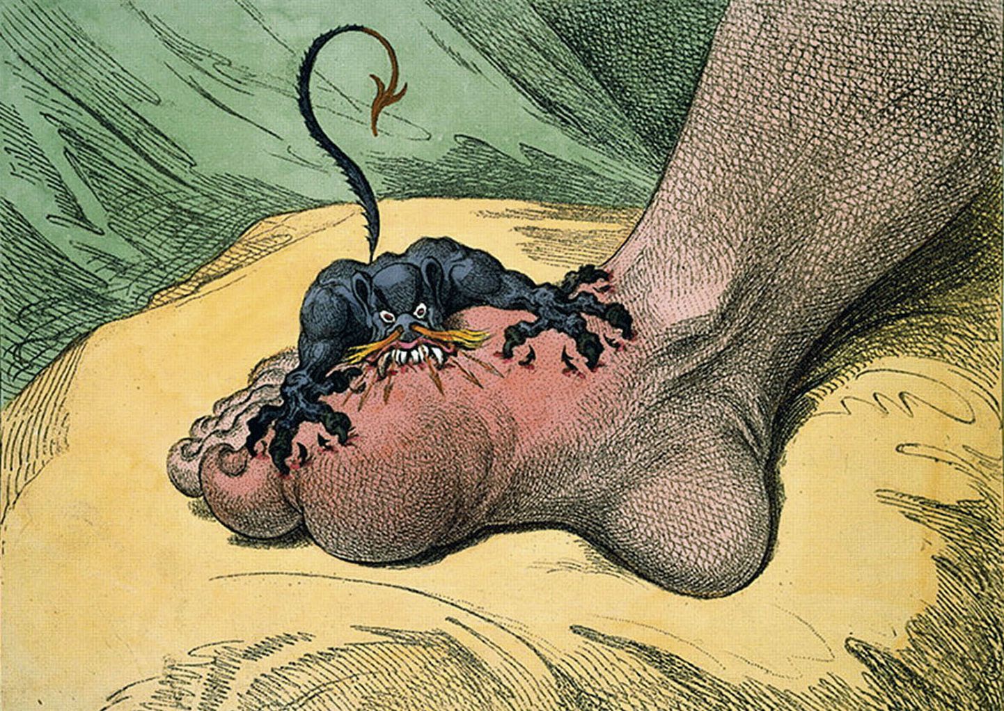 Podagra tuntuim sümptom on suurvarba põhiliigest tabav tugev valuhoog, mida 18. sajandi
karikaturist on kujutanud värvikal moel pahareti hammustusena