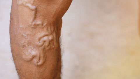 Jalgade sügelus ja turse võivad anda märku levinud probleemist