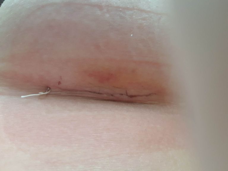Teisel fotol on silikooni paigaldamiseks tehtud lõike arm kuus päeva pärast lõikust.