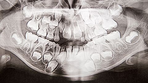 Puseriti hammastega laps ei vaja teatud juhtudel ortodondi abi