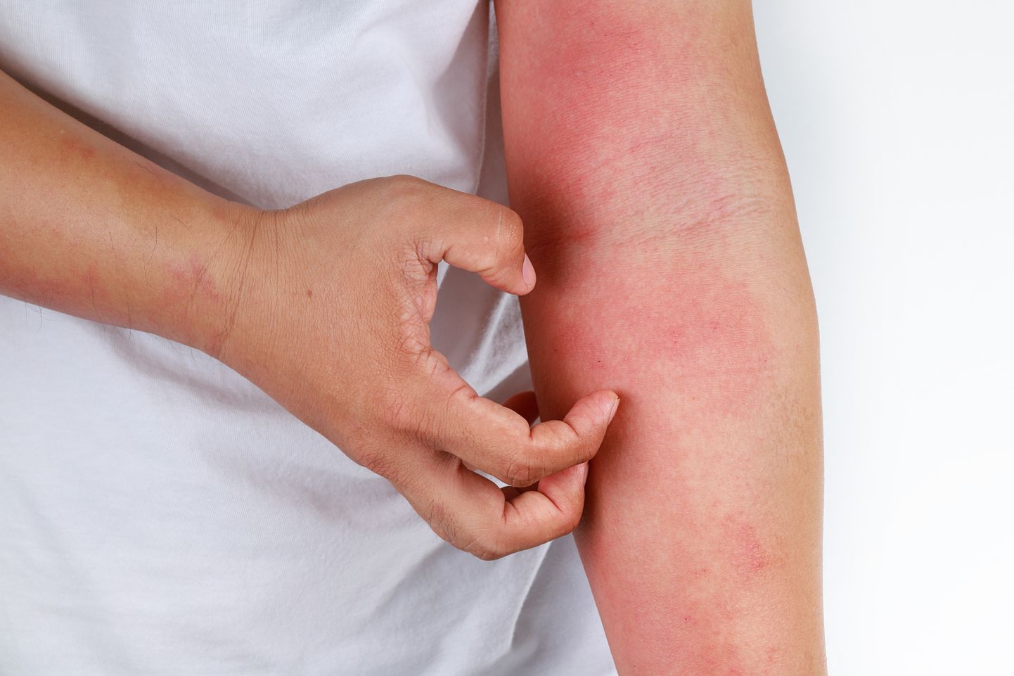 Hiljutise uuringu kohaselt on eriti käte ja jalgade nahalööbed sageli esimesed ja ainsad koroonaviirusega nakatumise tunnused.
