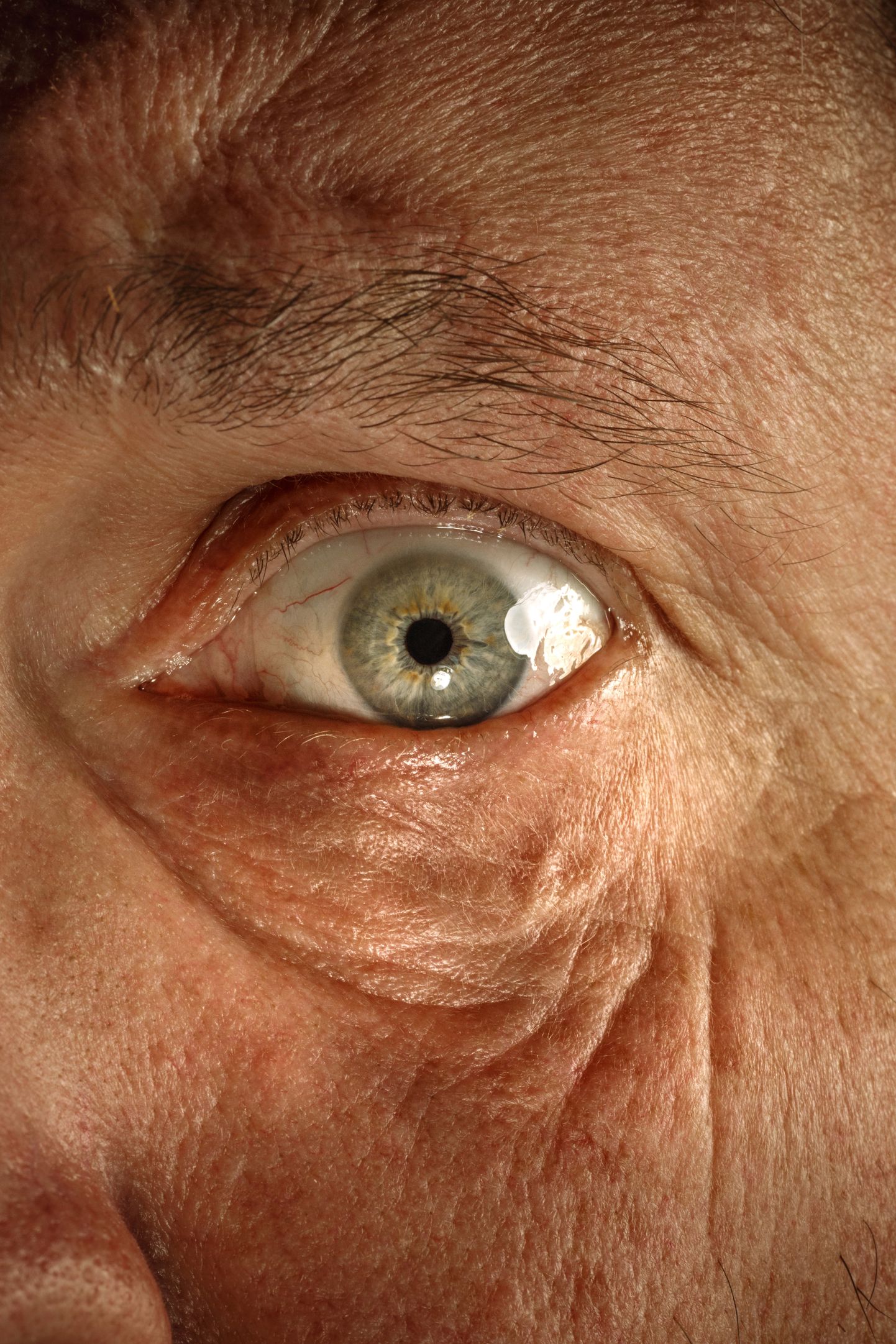 Silmades toimuvad Alzheimeri tõve puhul muutused.