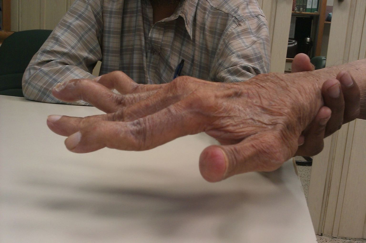 Sõrmeliigeste deformeerumine luigekaelakujuliseks võib olla tingitud liigesehaigustest, näiteks reumatoidartriidist (fotol) või traumast.