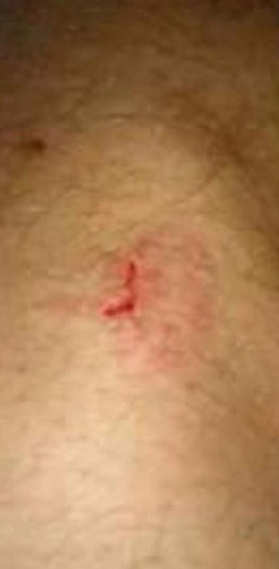 Jim McAlisteri jalg pärast hammustamist. Foto: Twitter