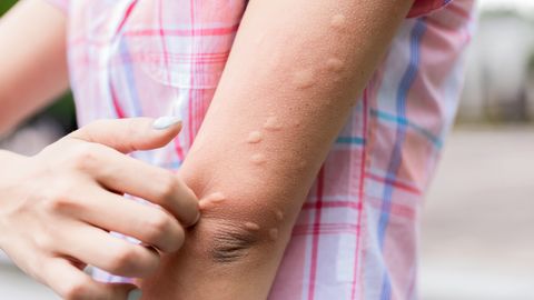 Четыре способа облегчить зуд и отек от укусов комаров