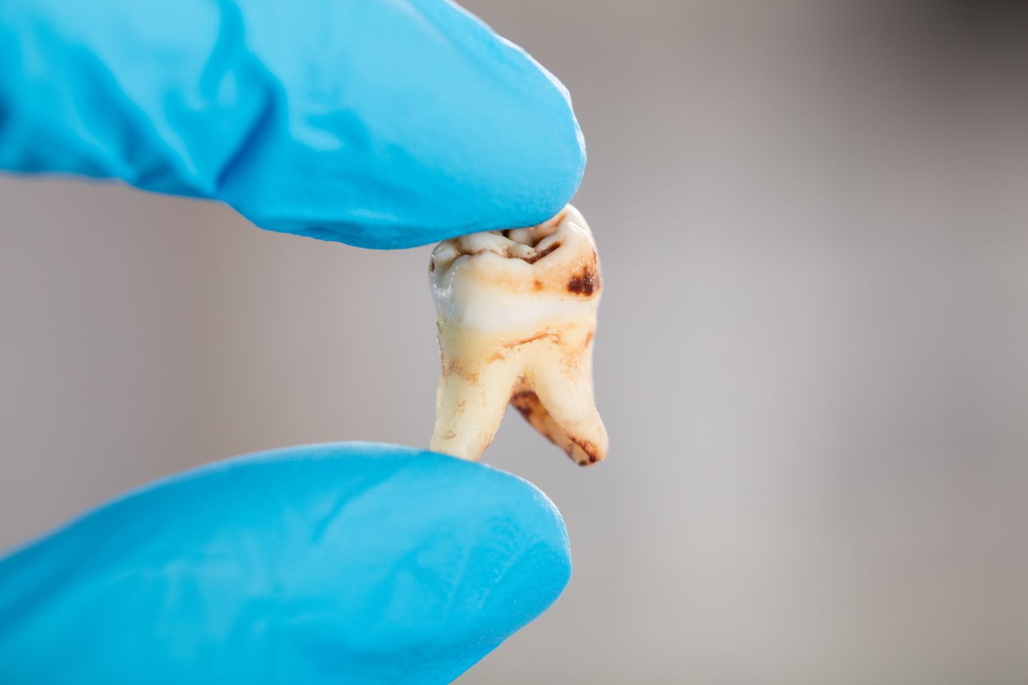 Kui hammaste tervisest ei hooli, võib nende kehv olukord tingida lausa väljakukkumise.